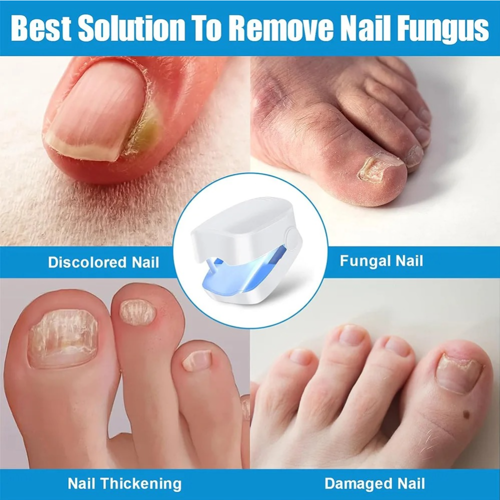 UV Nail Fungus Laser Treatment