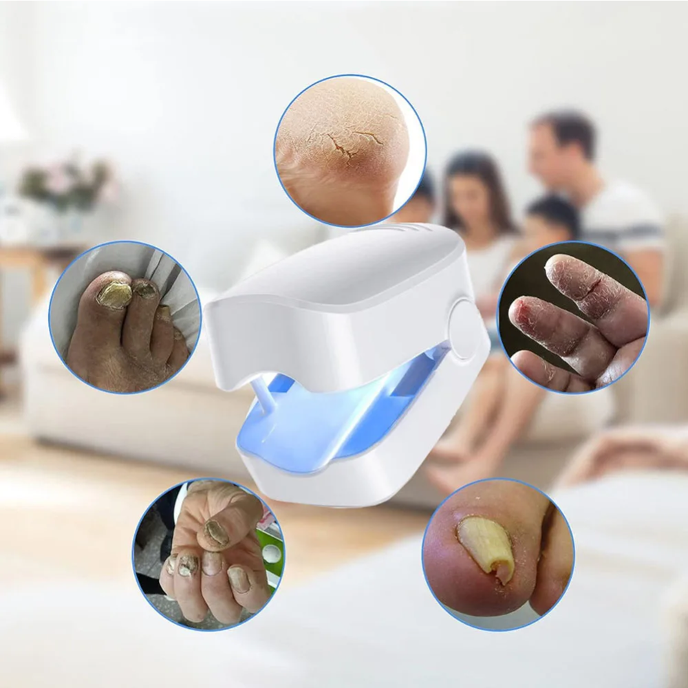 UV Nail Fungus Laser Treatment
